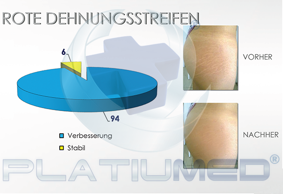 dehunungsstreifen