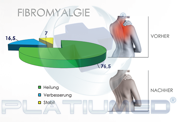 fibromyalgie