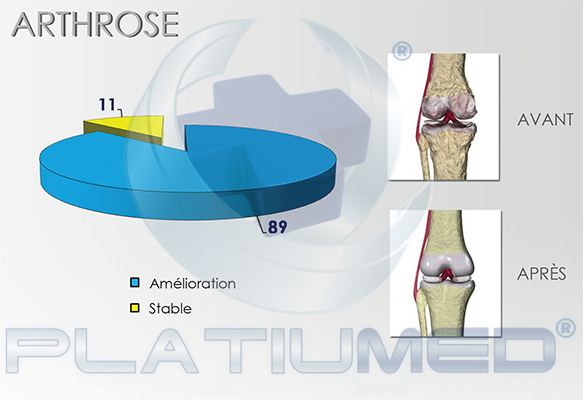 arthrose