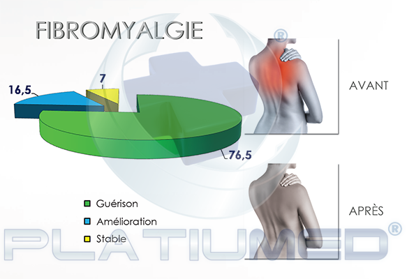 fibromyalgie