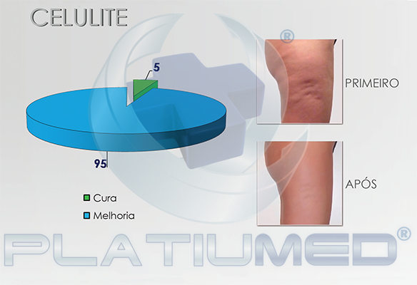 celulite