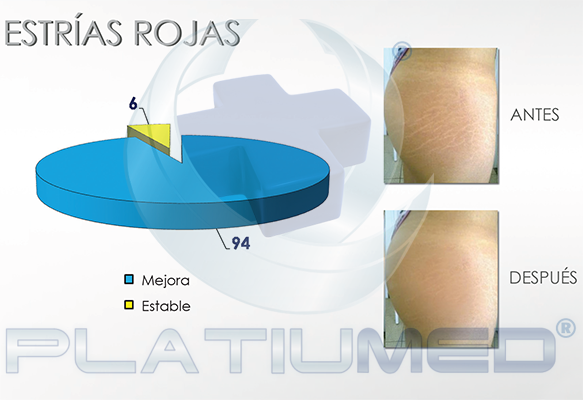 estrias rojas